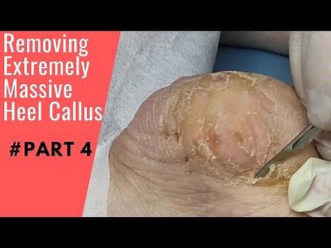 Removing Extremely Massive Heel Callus - Bones Under Pressure - Foot Care Callus Podiatry #Part 4