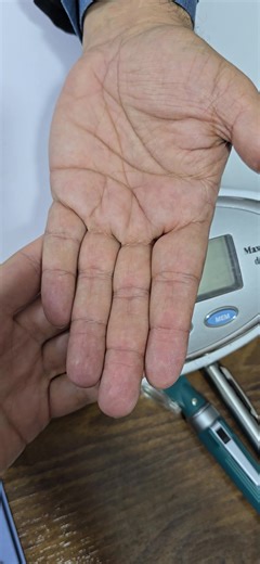 Understanding Trigger Finger: Causes and Treatments