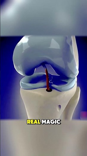ACL Reconstruction Surgery (3D Animation)