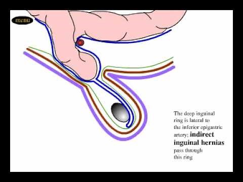 Direct and indirect inguinal hernia