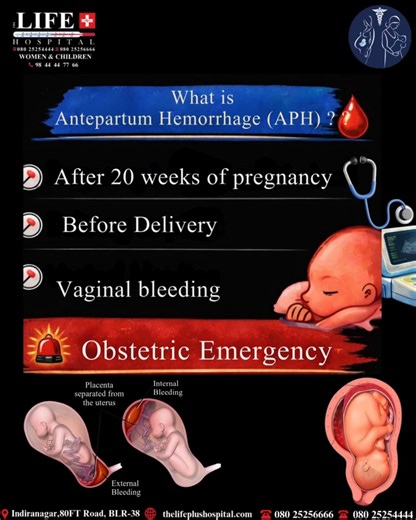 LifePlus Hospital on Instagram: "Antepartum Hemorrhage (APH) refers to bleeding from the genital tract after 28 weeks of pregnancy and before delivery. It is a serious condition that needs immediate medical attention. 📍 Indiranagar, 80FT Road, BLR-38 📞 9844447766 | 080 25254444 | 080 25256666 🌐 thelifeplushospital.com #AntepartumHemorrhage #APH #PregnancyComplications #HighRiskPregnancy #MaternalHealth #PregnancyAwareness #WomensHealth #ObstetricCare #SafePregnancy #GynecologyCare #DoctorExpl