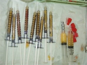 Eyelid and Facial Fat Injection Specialists Los Angeles CA