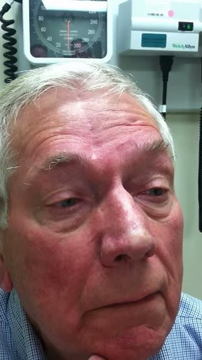 Cogan's twitch and eyelid hopping