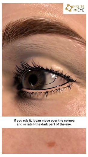 Eyelash Stuck in Eye? It Can Cause Redness, Blurry Vision & Corneal Ulcer! Dr Anisha Gupta