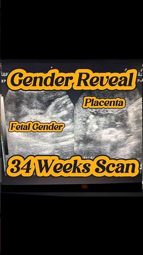Fetal Gender Reveal on ultrasound | Obs Scan | 34 weeks ultrasound