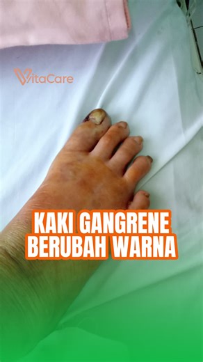 Kaki Gangrene: Tanda dan Penyelesaian Vitacare