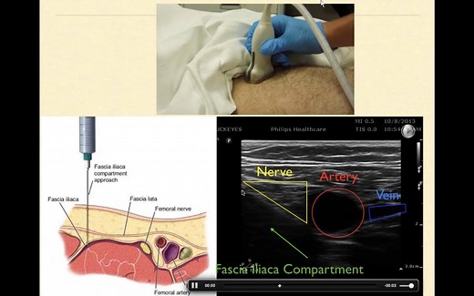Fascia Iliaca Compartment Block