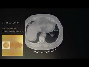 CT evaluation - "the crazy paving pattern"