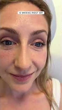 Lower blepharoplasty fat repositioning fat grafting and co2 laser