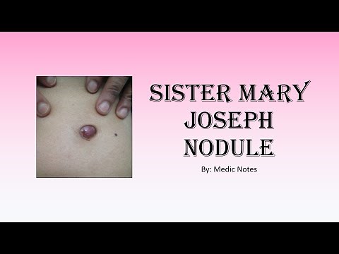 Sister Mary Joseph nodule - causes, pathophysiology