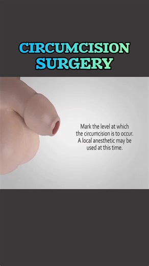 #circumcissionsurvivor #circumcissionsurgery #circumcision #circumcission #3dmedicalanimation