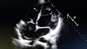 Chiari network in the right atrium. Normal anatomical variant. | Ahmed Mohsen