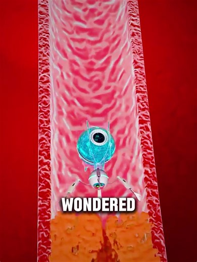 Robotic Atherectomy | How Robots Clear Blocked Arteries! #roboticatherectomy #atherectomy #hearthealth #cardiology #medicalanimation