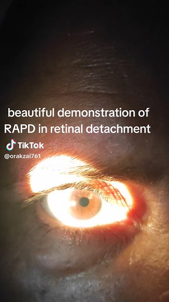 Understanding RAPD in Retinal Detachment | Visual Impairment Explained