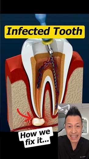 Tooth Infection Treatment: What to Expect at the Dentist #theeverydaydentist #dentist #shorts