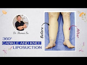 Lipedema Liposuction | 360° Cankle & Knee Surgery | Artlipo | Expert Dr. Thomas Su