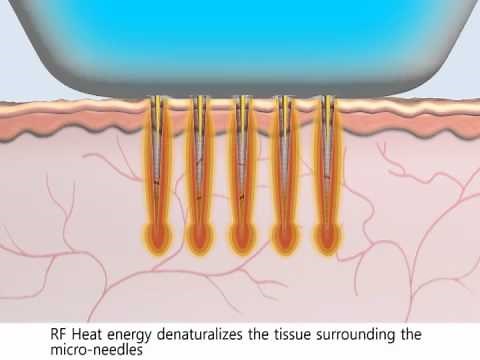 Animation Radiofréquence MicroNeedle Secret