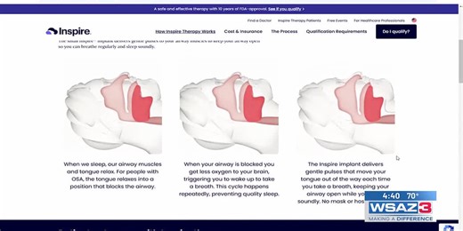‘Inspire’ sleep apnea treatment