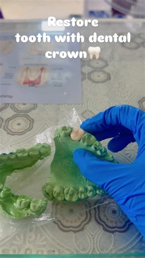 RCT Treated Tooth Dental Crown 👑 🦷#dentalcrown #oralhealth #doctor #shortsfeed