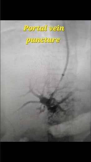 Trans jugular intrahepatic porto systemic shunt (TIPS) procedure