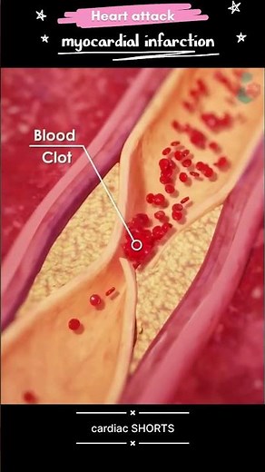 What is a HEART ATTACK Explained in 3D Animation? #shorts #youtubeshorts
