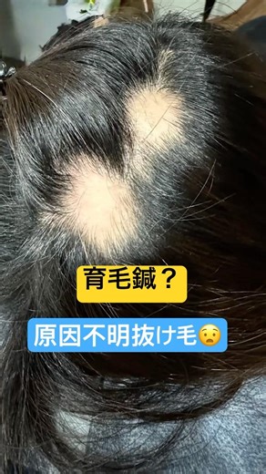 原因不明の抜け毛で困惑😧ググって当院へ#育毛鍼 #育毛 #抜け毛 #毛バリ #薄毛 #円形脱毛症 #aga