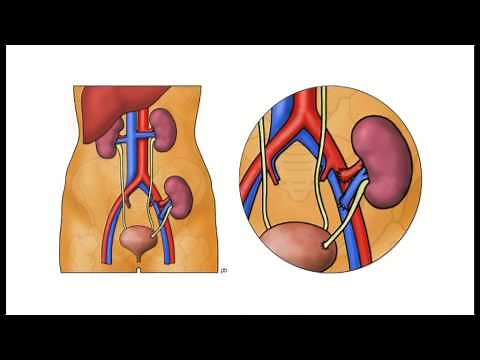 Kidney Transplantation - The Operation