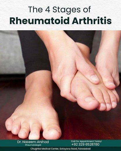 Don’t Ignore These Signs! 4 Stages of Rheumatoid Arthritis #rheumatoidarthritis