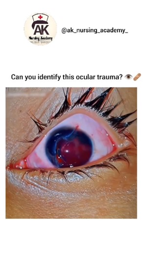 Ak Nursing Academy on Instagram: "A corneal tear is a true medical emergency! 🚨👁️ A corneal laceration is a partial or full-thickness cut through the cornea, often caused by sharp objects or high-velocity trauma. This can lead to a "flat" anterior chamber and potential loss of intraocular fluid (aqueous humor). 🩺 Nursing Priorities & Management: Do NOT Apply Pressure: Never put a traditional patch or pressure on the eye; it can cause the internal contents to extrude (leak out). Eye Shield: Pl