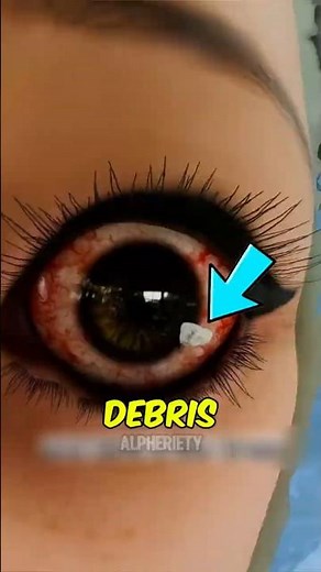 Something in Your Eye NEVER Do This 😳