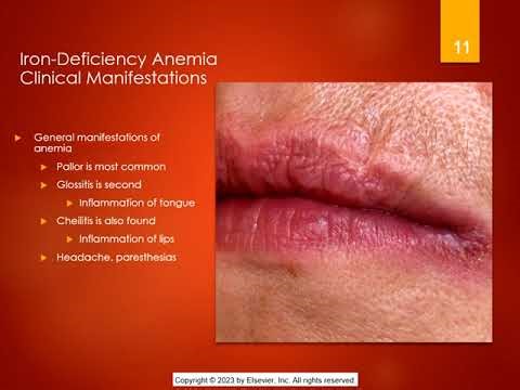 Chapter 34 Hematological Problems Power Point Lecture