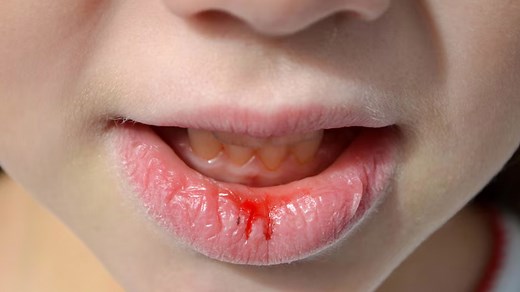 What is Lip Cancer? Understanding Signs, Causes, and Treatment