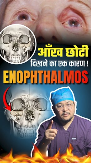 Aanhke choti ho rahi hai ?? Enophthalmos ??