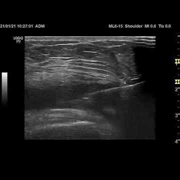 Ultrasound guided intraarticular knee-injection.