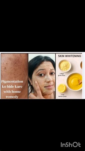 best home remedy for pigmentation dark sport#skincare #pigmentation #india