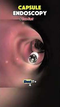 Swallow a Camera? Capsule Endoscopy Unveiled! Inside Your Gut #healthtips #medical #CapsuleEndoscopy