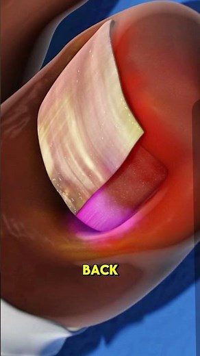 Ingrown Toenail Procedure 3D Animation