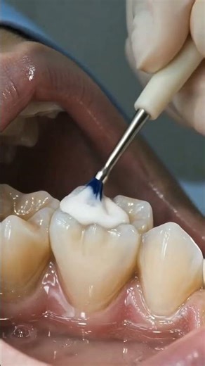 Satisfying Deep Dental Cleaning 🦷✨ | Plaque & Tartar Removal Transformation #dentalcleaning#Shorts