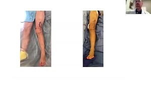 Deformity Correction With Exramedullary & IM Lengthening Nail