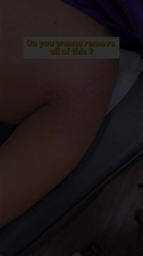 Stretch Mark Removal Cream Available with Guaranteed Results