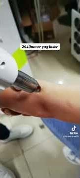 2940nm erbium yag laser mole cutting