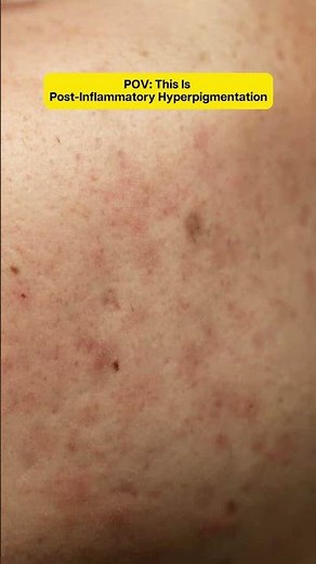 PIH happens after acne, inflammation, or irritation.