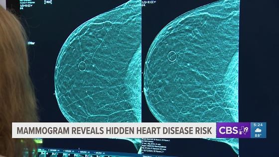 HEALTH: Mammogram reveals hidden heart disease risk