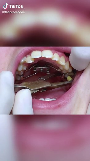 POV: you’re getting your expander out 💯