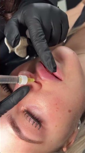 Russian Lip Injecting
