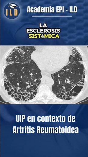 Causas de Patrón UIP en la Tomografía Computada 🤯 #fibrosispulmonar