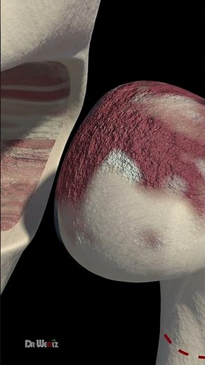 Hip Replacement Explained