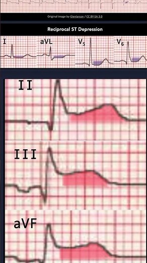 Acute Inferior ST elevation myocardial infarction (STEMI) ECG