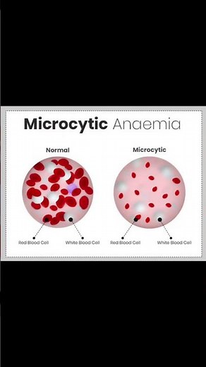 Anemia microcitica