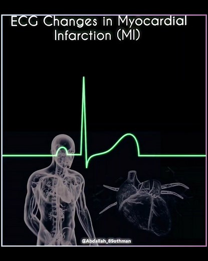 🔁 Repost ⚡🫀Understanding ECG Changes in Myocardial Infarction (MI): https://lnkd.in/drXXPZpf A Visual Timeline From acute ST elevation (within hours) to pathological Q wave development (12h), T wave inversion (days-weeks), and chronic Q wave persistence (months-years), with ST normalization by 1 month and T wave recovery by 1 year. This video illustrates the progression for better diagnostic insight. https://lnkd.in/dBdEPwJ5 #Cardiology #ECG #MyocardialInfarction #HeartResearch #MedicalEducati